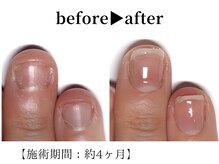 リング ザ ベル(ring the bell)/深爪プレミアムコース¥18,700