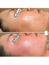 エレナ 伊勢崎(Ele'na)/ニキビケア