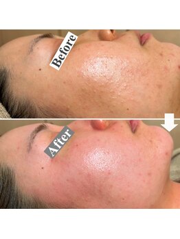 エレナ 伊勢崎(Ele'na)/ニキビケア