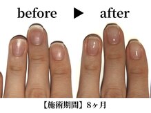 リング ザ ベル(ring the bell)/深爪スタンダードコース¥11,000