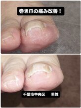 巻き爪じゅん 千葉駅前店/【巻き爪の痛みが即日改善！】