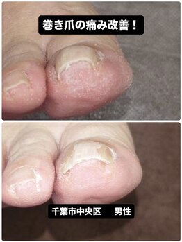 巻き爪じゅん 千葉駅前店/【巻き爪の痛みが即日改善！】