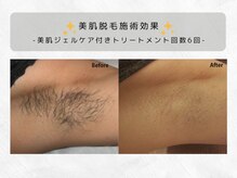 ヴィキ 北千住(VIKI)/【美肌脱毛】ワキbefore/After