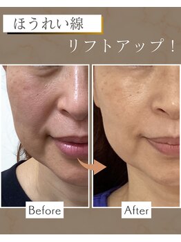 けいのき鍼灸整骨院の写真/年齢を重ねるごとに気になるお肌のお悩みを改善！鍼施術でお肌の内側からアプローチし美しく♪ハリツヤUP！