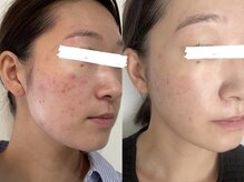 デューン 蕨店(Dune)/before/after20代後半女性