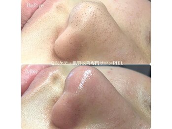 ピエル 北千住店(PIEL)/エクストラクションで劇的変化