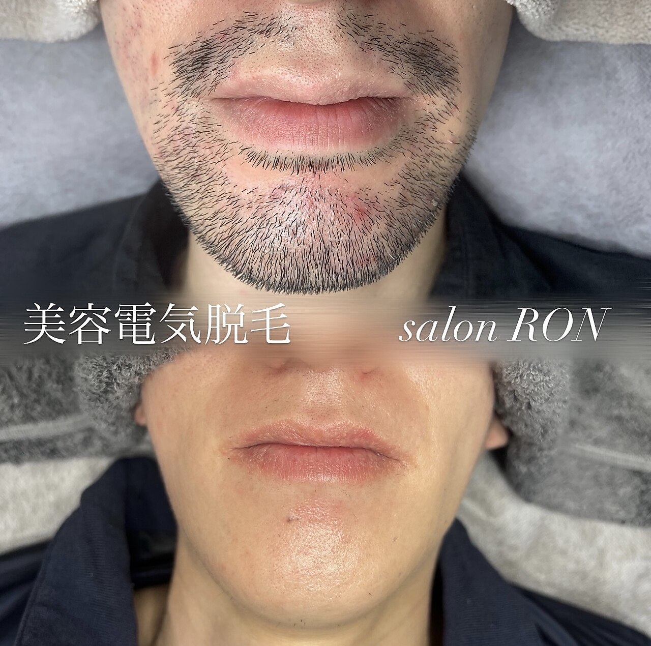 K2-ron 脱毛器 10段階設定 LCDディスプレイ ロン(RON)｜ホットペッパービューティー