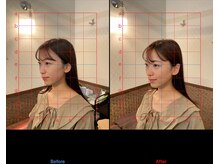 チャチャエイム整骨院 鍼灸院/美容鍼ビフォーアフター