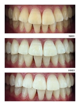ホワイトニングショップ 刈谷店/回数を重ねればムラもなくなる！