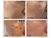 最新！新しいシミケア♪詳細はフォトギャラリーへ【たるみシミ】