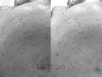 ルノン(Lunon)/ララピール