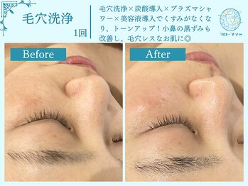 フローフシ∞/【毛穴洗浄】くすみ改善