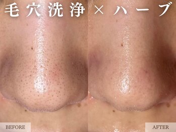 レヴェリー 心斎橋店(REVERIE)/-毛穴洗浄×ハーブ-