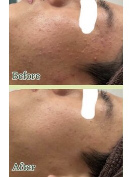 サロンド ヴィーナス 葛西店/ハーブピーリングでニキビ対策