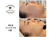 人気No.2【脱たるみ毛穴】BBL光フェイシャル×ヒト幹細胞20900円→9900円