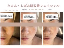 エステティックサロン シーズ/しぼみ肌をハリ肌へ
