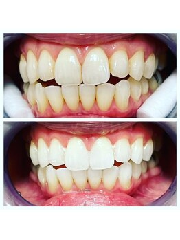 ホワイト 金沢店/通い放題コースゴールドのお客様