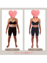 トレゾアスィス(Tresor sis)/痩身/ダイエット/筋膜リリース