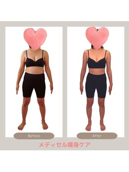 トレゾアスィス(Tresor sis)/痩身/ダイエット/筋膜リリース