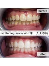 ホワイト 天王寺店(White)/Whitening症例before→after