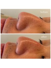 ネオファースト 大阪福島店(NeoFirst)/毛穴の角質撲滅！#毛穴#ハイドラ