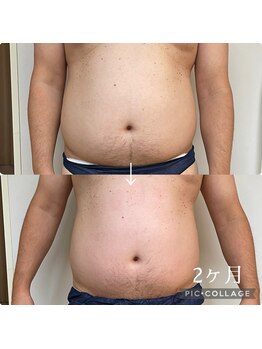 リリーローズ(LilyRose)/おなかやせ