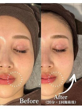 フェミューズアカサカ(FEMUSE AKASAKA)/水玉スキン