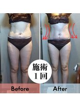 アルカディア(Arcadia)/セルゼロ１回施術