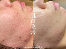 ラティーナ(Lattina)の雰囲気（肌質改善/多数ピーリング取り扱い♪/ニキビケア/毛穴）
