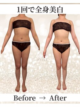ドレス(dress)/全身痩身Before/After