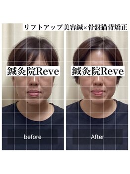 わきさか鍼灸整骨院・鍼灸院 レーヴ(Reve)/before after