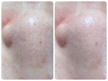 トータルビューティ ノイド(Noid)/毛穴洗浄　いちご鼻小鼻のみ