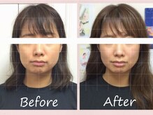 ビーレ袋町/[小顔矯正]左右差気になる方に