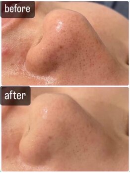 ネオファースト 大阪福島店(NeoFirst)/ハイドラ毛穴洗浄#毛穴#毛穴洗浄