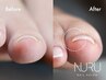 【フットネイル】巻き爪矯正 親指2本 (オフ無し）/フットネイル