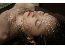 オリエントセラピー(ORIENT THERAPY)の雰囲気（規格外の鍼であるルート鍼。隔絶した結果を求められる方は是非。）