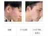 メンズフェイシャル【リベル】ハーブピーリング〈剥ける〉