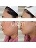 40,50代《口元の老け見えを徹底ケア》　小顔 ウルドム+骨格調整+白玉酸素Dome
