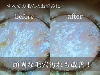 キャロリーヌ新宿店/長年の毛穴悩みが改善