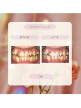 プラスビーセルフ(+b self)/ホワイトニングビフォーアフター