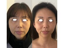 アニュー(anew.)/【Lit症例】フェイシャル