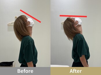 せなかのはね 難波心斎橋店/20代 女性 首こり 猫背 肩こり