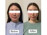 [No.1 for International Guests) Cosmetic Acupuncture × Small Face Lift