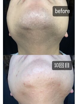 ヴィーナス(Venus)/髭脱毛 before→10回目