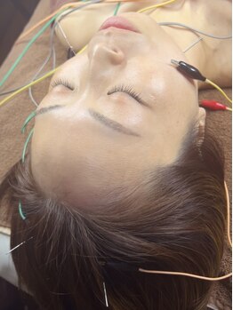 サラン鍼灸院(SARAN都楽鍼灸院)/電気美容鍼灸でリフトアップ