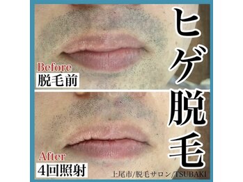 ツバキ(TSUBAKI)/ヒゲ脱毛