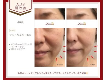 リュミエール(Lumiere)/【症例】ADS肌改善