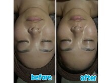 ラクラク(rakuraku)/リフトアップフェイシャル/30代