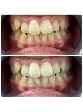 グリッター ショウナン(glitter. SHONAN)/藤沢ホワイトニングbefore/after