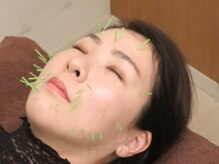 ハーモニープラス/美容鍼灸2